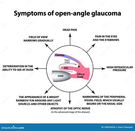 Open Angle Glaucoma A Common Type Of Glaucoma The Anatomical