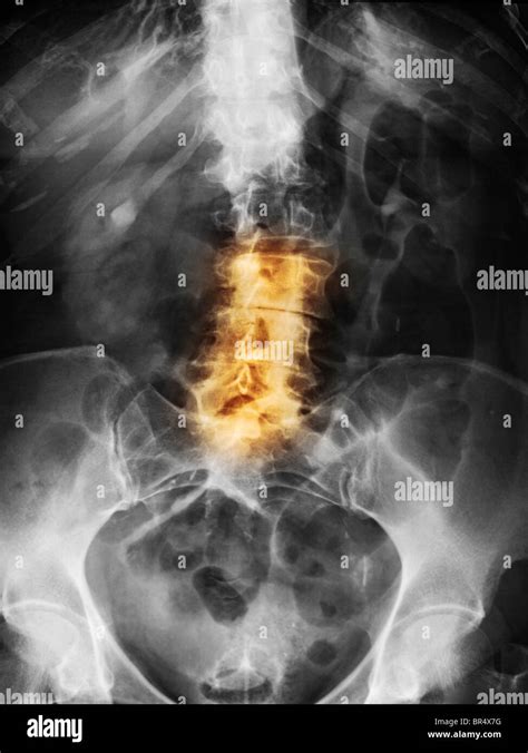 Lumbar Spine X Ray Of A 79 Year Old Woman With Degenerative Arthritis