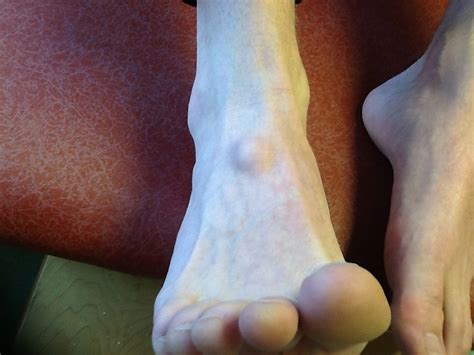 Although they are not cancerous, they can be quite painful. Foot and Ankle Problems By Dr. Richard Blake: Ganglion Cysts