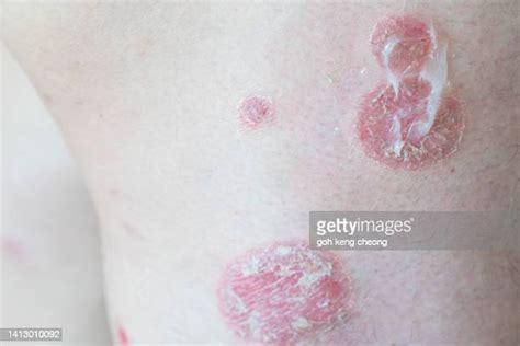 Eczema Blisters Photos And Premium High Res Pictures Getty Images