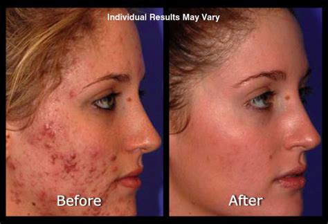 Laser Treatment For Acne Reviews