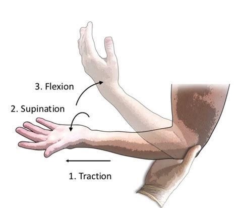 Radial Head Subluxation Core Em