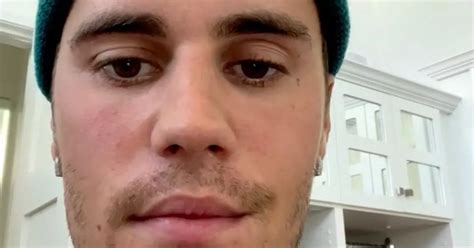 Justin Bieber Shares Ramsay Hunt Syndrome Diagnosis And Shows Facial