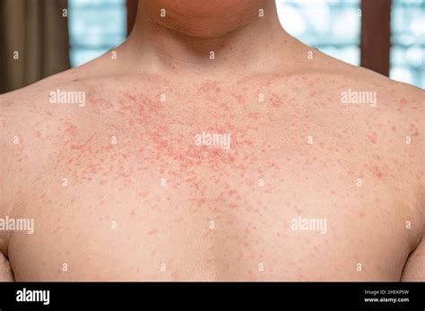 Dermatitis Rash Viral Disease With Immunodeficiency On Body Of Young