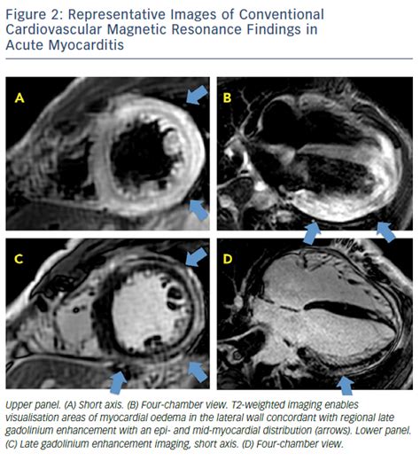 Journal of the american college of cardiology. Advances in Cardiovascular MRI using Quantitative Tissue ...