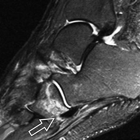Mri Of Isolated Cuboid Stress Fractures In Adults Ajr