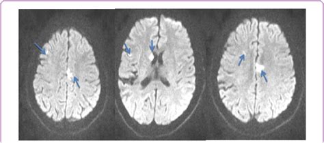 Mri Brain Axial Dwi Images Showing Restriction Of Diffusions In