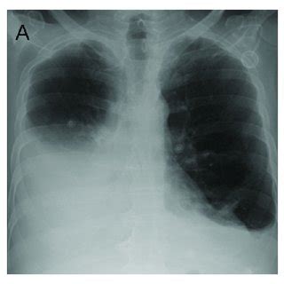 A Preoperative Chest X Ray B Chest X Ray One Day After