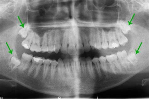 Wisdom Teeth Removal Facts You Need To Know About Extraction And