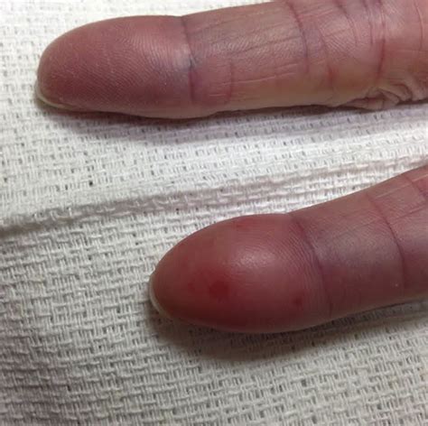 Elderly Woman With Painful Swollen Fingers Annals Of Emergency Medicine