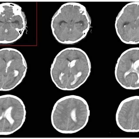 Head Ct On Admission Shows Diffuse Intraventricular Hemorrhage Ivh