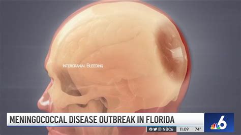 Meningococcal Disease Outbreak In Florida Nbc 6 South Florida