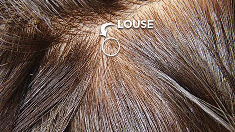 Head Lice Screening How To Tell If You Have Lice