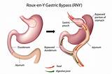 Long Term Side Effects Gastric Bypass Surgery