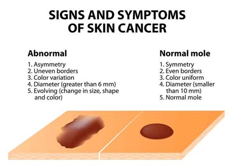 Photos Of Skin Cancer Symptoms Are Great Tools The Riverenza