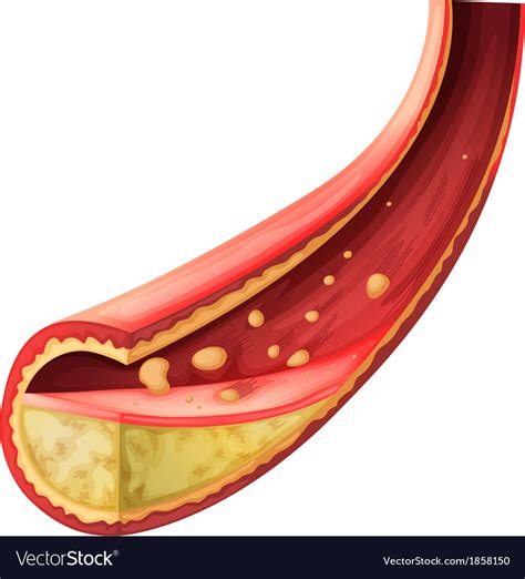 Artery Blocked With Cholesterol Royalty Free Vector Image