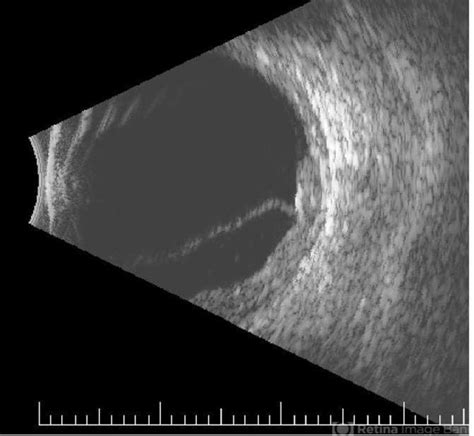 Choroidal Metastasis B Scan Retina Image Bank