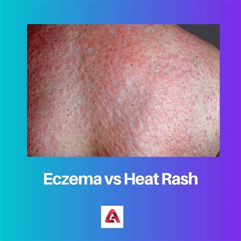 Difference Between Eczema And Heat Rash