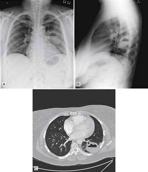 Lung Abscess Thoracic Pathology A Volume In The High Yield Pathology