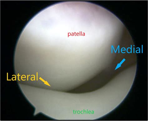 Lateral Retinacular Release For Treatment Of Excessive Lateral Pressure
