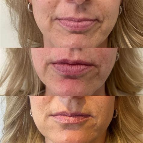 Smooth Your Facial Wrinkles And Folds With Vollure Filler