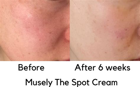 My Honest Musely Review With Before And After Discount Organic