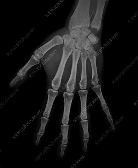 Healthy Hand X Ray Stock Image F0393312 Science Photo Library