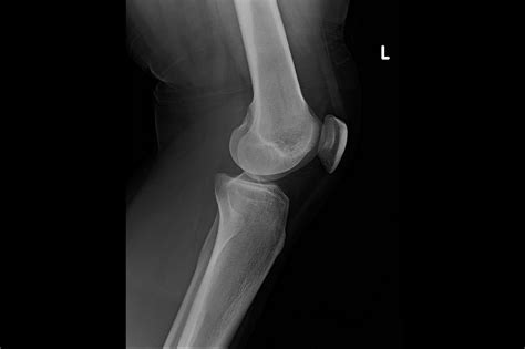 Ortho Dx Knee Pain After A Fall Clinical Advisor