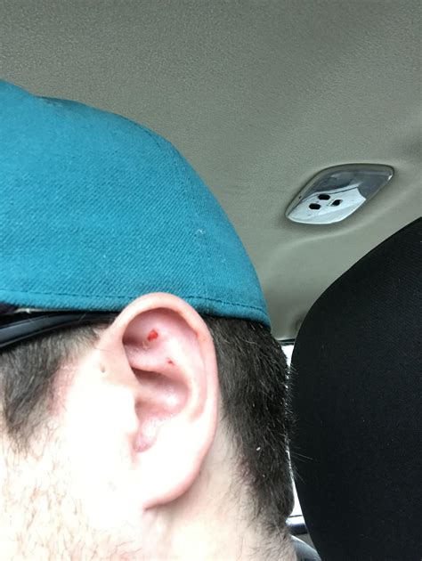 Scratched My Ear Psoriasis