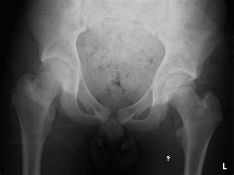It usually occurs during vigorous sport activity. Sequential bilateral lesser trochanter avulsion fractures ...