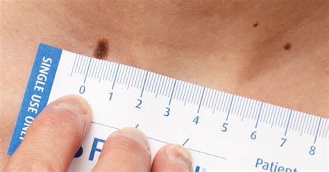 Skin Cancer 6 Ways To Check Your Moles Huffpost Life