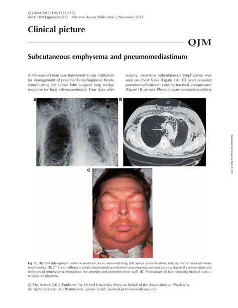 Pdf Pneumomediastinum And Subcutaneous Emphysema Due To Blunt Neck