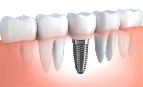 What You Should Know About Dental Implants Before Getting One Monarch