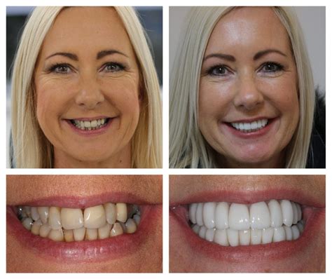 The Benefits Of Veneers That Will Improve My Smile Mymeditravel Knowledge