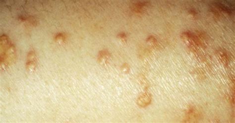 10 Diabetic Skin Problems Skin Problems And Diabetes