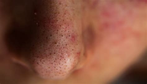 Blackheads What They Look Like Treatment And Prevention