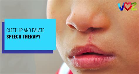 Cleft Lip And Palate Speech Therapy Voz Speech Therapy Speech Therapist In Washington Dc