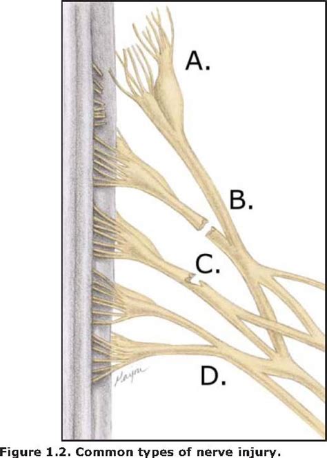 Brachial Plexus Injury Expert Specializing In Erb S Palsy And Brachial