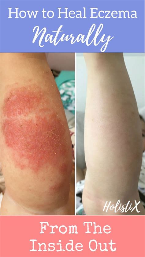 How To Heal Eczema Naturally From The Inside Out Holistic Health