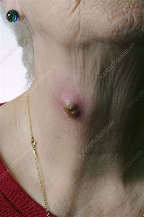 Infected Cyst On The Neck Stock Image C0117550 Science Photo Library