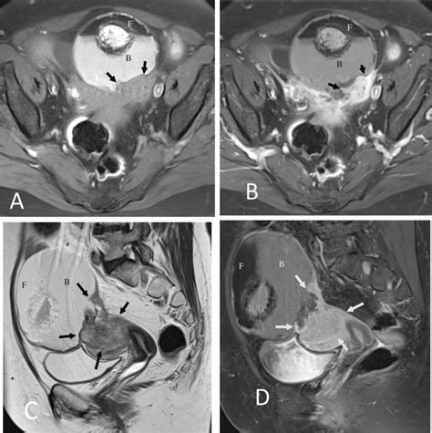 Malignant Transformation In A Mature Cystic Teratoma Axial Pre A And