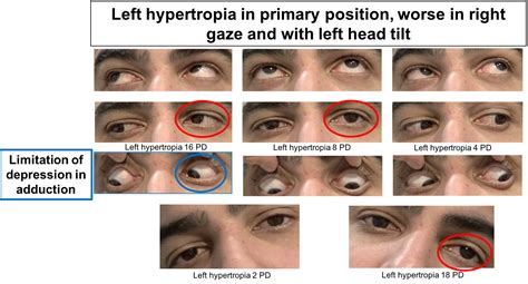 Cranial Nerve Palsy CN III IV VI VII Palsy OFF