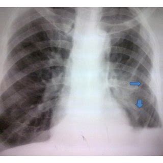 •pneumothorax / hemothorax •massive pleural effusion •empyema •post operative procedures eg 7. (PDF) Tube Thoracostomy: Complications and Its Management