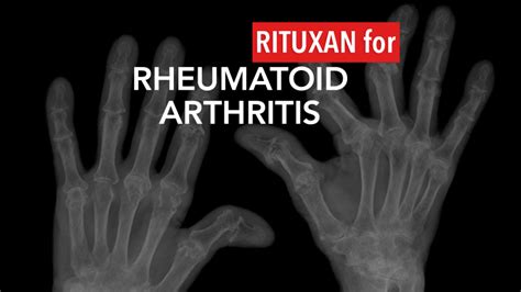 Rituxan Treatment In Rheumatoid Arthritis The Arthritis Connection