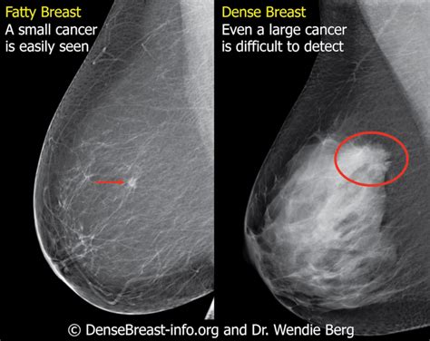 Breast cancer — comprehensive overview covers prevention, symptoms, diagnosis and treatment you will receive the first breast cancer email in your inbox shortly, which will include information on women who have never been pregnant have a greater risk of breast cancer than do women who. Dense Breast "Inform" Laws Can Vary, Why it Matters | Joan ...