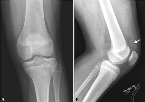 Left Knee Pain And Bilateral Knee Swelling In An Adolescent Semantic