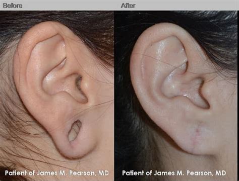 Plastic Surgery For Gauged Earlobes Before And After
