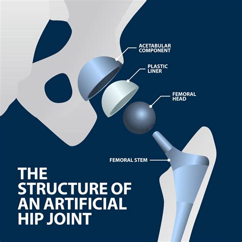 Total Hip Replacement Anterior Approach Florida Orthopaedic Institute
