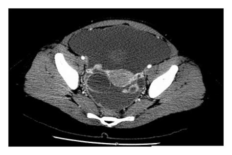 Ct Scan Showing Rim Enhancing Cystic Lesions In The Right And Left