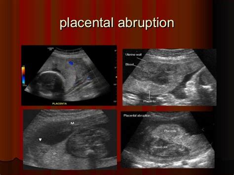 Placental Abruption Ultrasound